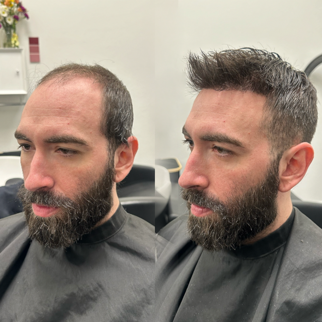 Hair unit coverage example for Alpharetta, Georgia